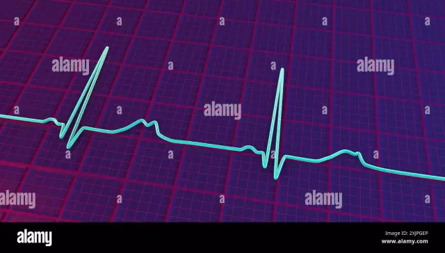 Sinus ritmi aritmiyaga olib keladimi?