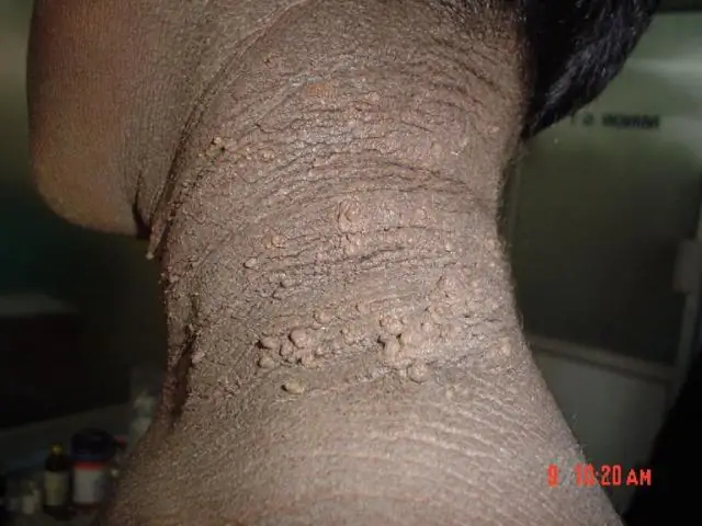 Pôjdu acanthosis nigricans?